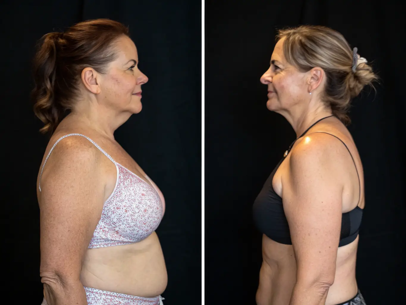 A before-and-after photo demonstrating the results of a body contouring treatment, showcasing the sculpted and defined figure achieved through non-invasive procedures.